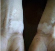 白癜风反复发病的原因是什么呢