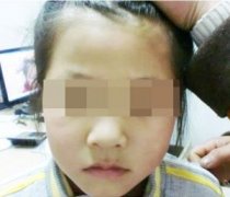白癜风的日常护理应注意什么