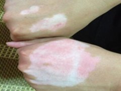 如何进行自我检查白癜风
