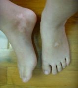 白癜风一开始的症状表现是什么