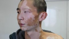 白癜风中断治疗会有哪些危害