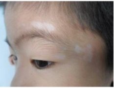 白癜风有哪些预防小技巧