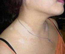 白癜风对女性的身体有什么危害