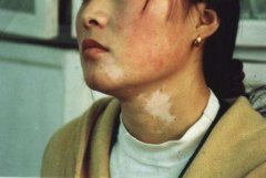 女性白癜风具体有什么危害