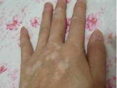 怎么诊断是不是女性白癜风