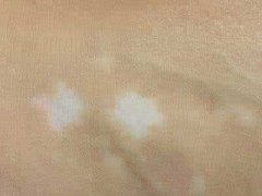 局限型白癜风的症状表现有哪些