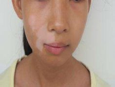 白癜风患者可以用什么化妆品