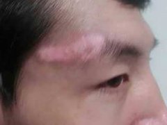 怎么才能预防白癜风的遗传