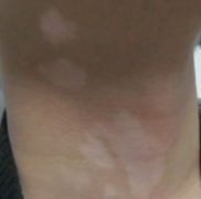白癜风会危害患者健康吗