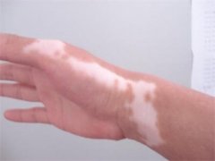 白癜风的预防从哪些方面做起