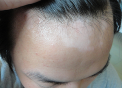 预防白癜风的方法都有什么