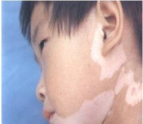 得了白癜风患者怎么护理呢