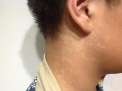 哪些因素会容易导致白癜风复发