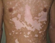 男性白癜风的病因会是些什么