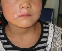 脸部白癜风患者要怎样护理