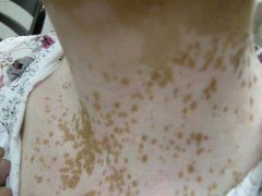 白癜风进行预防要做些什么