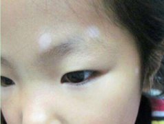 儿童患上白癜风会带来什么影响