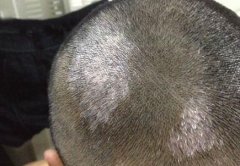 头部白癜风症状怎样
