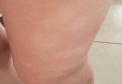 白癜风应该怎样预防好呢