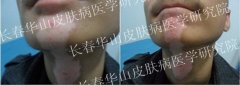 男性颈部白癜风4年
