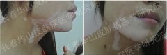 女性面部白癜风4年