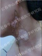 女性颈部白癜风4年