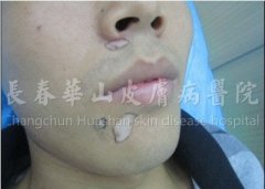 男性嘴角白癜风3年
