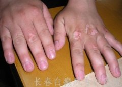 白癜风如何进行自我诊断