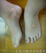 肢端型白癜风发病有什么症状
