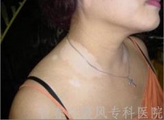 白斑病与白癜风有什么区别