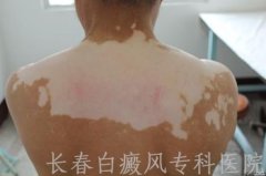 白癜风对身体的危害有哪些