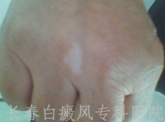 白癜风治疗为何要尽早