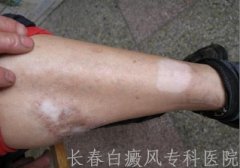 腿上有白癜风会遗传吗