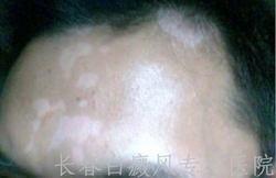 白癜风好转的症状