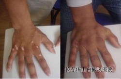 白癜风能彻底治愈吗