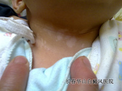遗传性白癜风能不能治愈