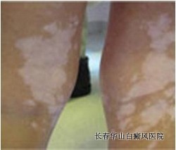 晚期白癜风能够治愈吗