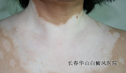 大面积的白癜风怎么治疗