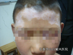 得了白癜风怎么治疗