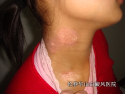 皮肤出现白癜风怎么治