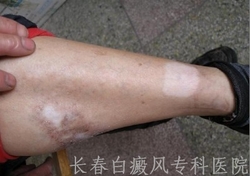 白癜风怎么预防同形反应