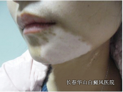 白癜风究竟能够治好吗