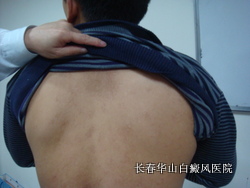 怎么会得了白癜风