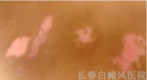 预防白癜风要注意什么