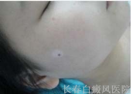 患了白癜风怎么诊断
