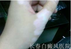 白癜风症状怎么治疗
