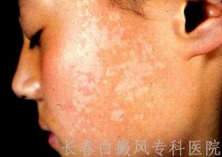 脸部白癜风的治疗方法