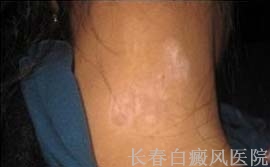 白癜风对患者的危害
