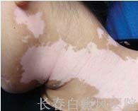 白癜风治不好的原因有哪些