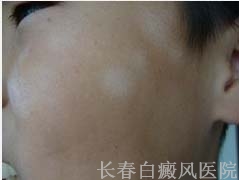 早期白癜风怎么治疗